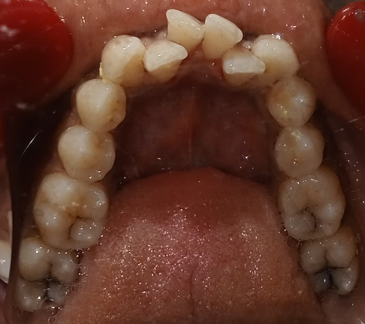 Before — lower occlusal