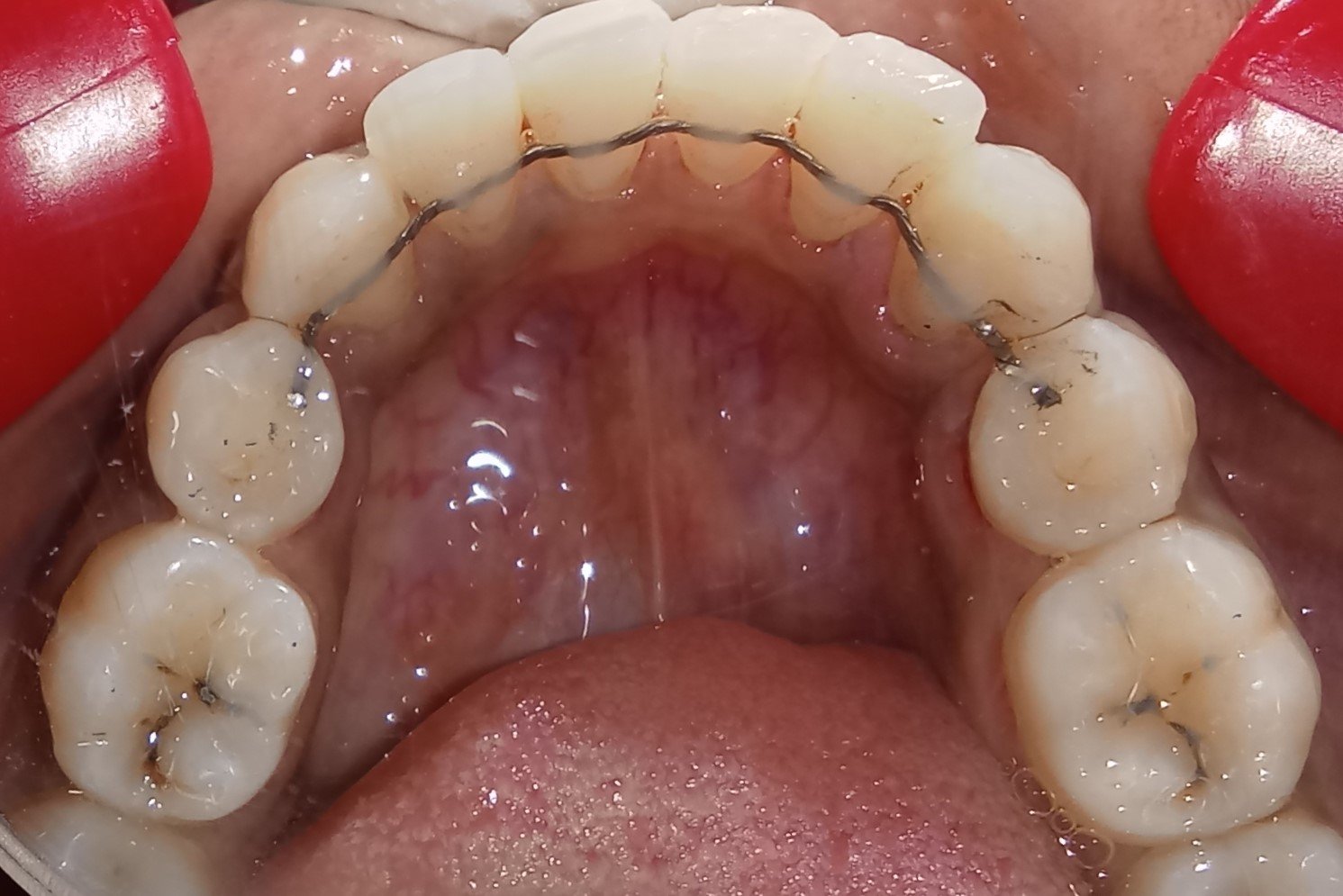 After — lower occlusal
