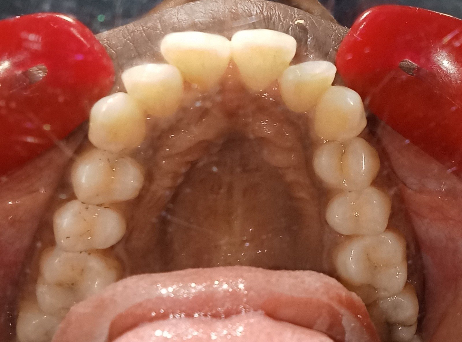 Before — upper occlusal