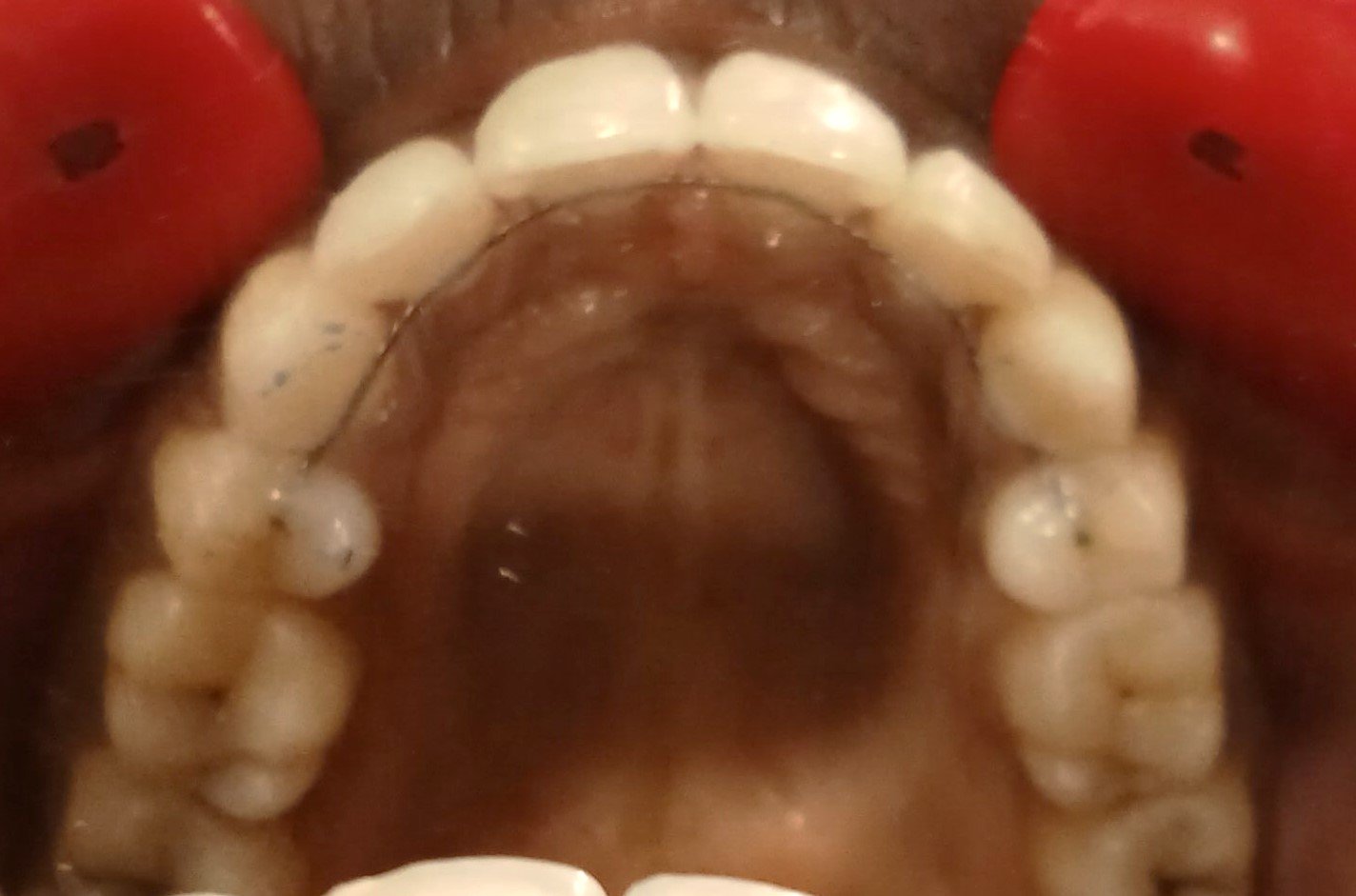 After — upper occlusal