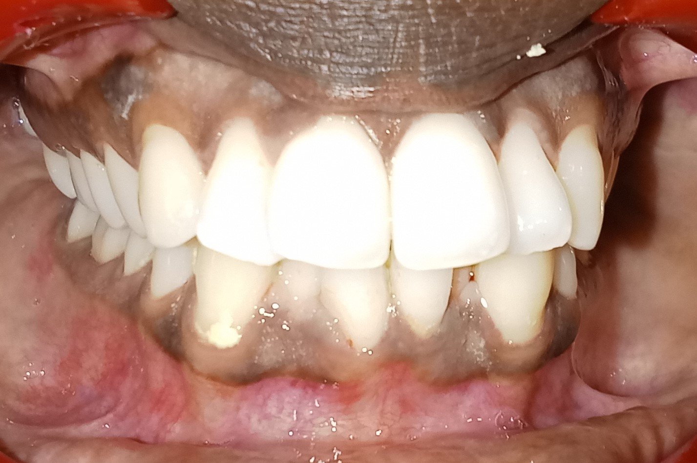 Before — frontal view