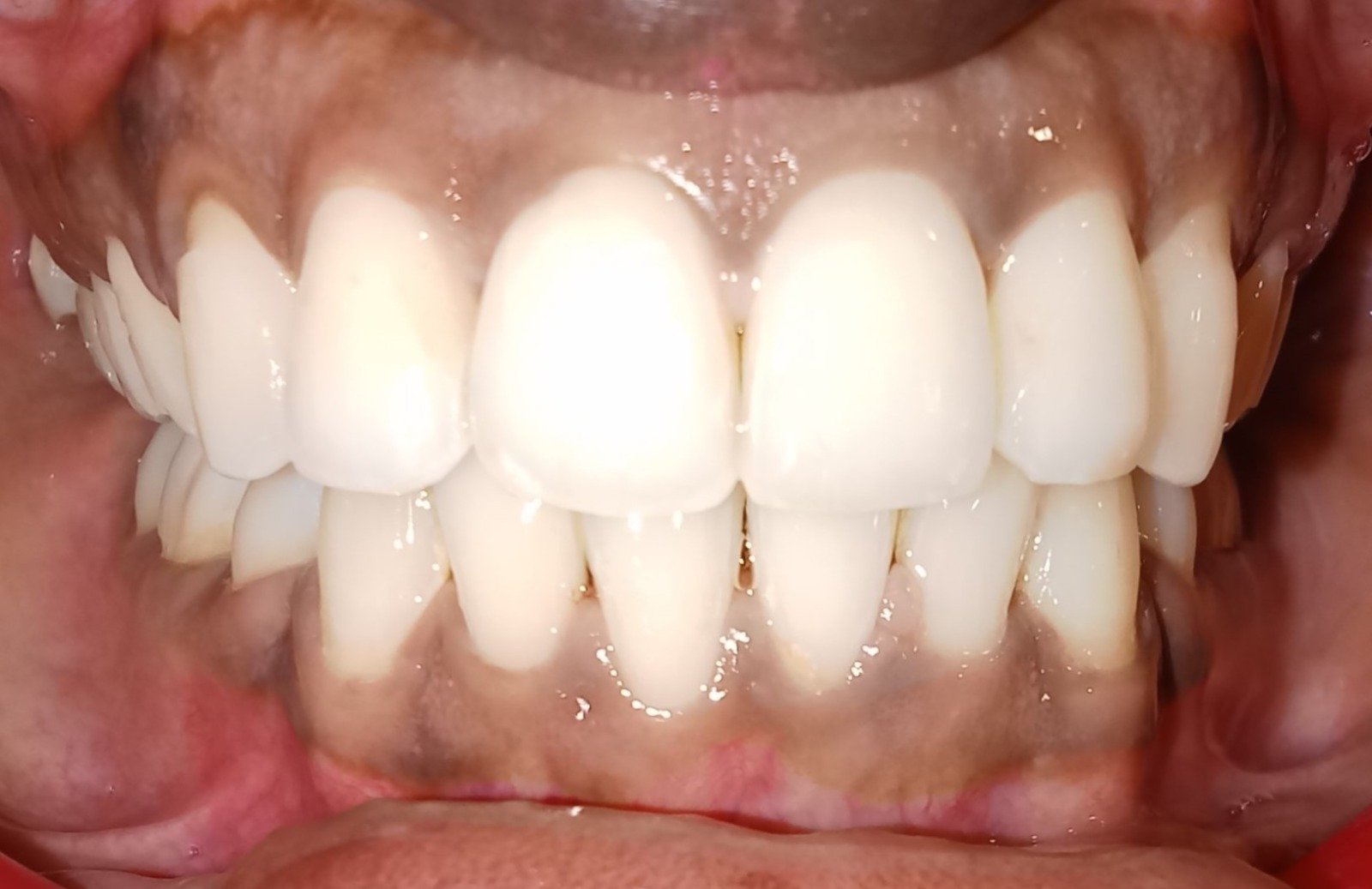 After — frontal view