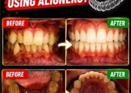 Orthodontic treatment videos