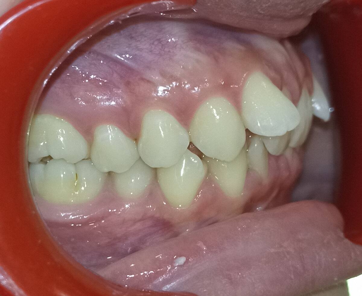Before — right lateral, Class II Division 2 deep bite and crowding