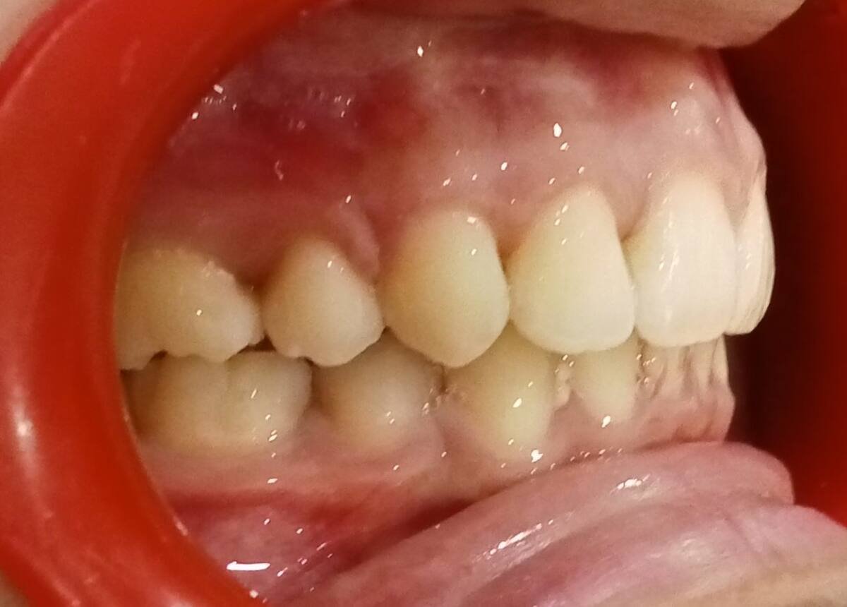 After — right lateral, Class I molar and canine, ideal overjet