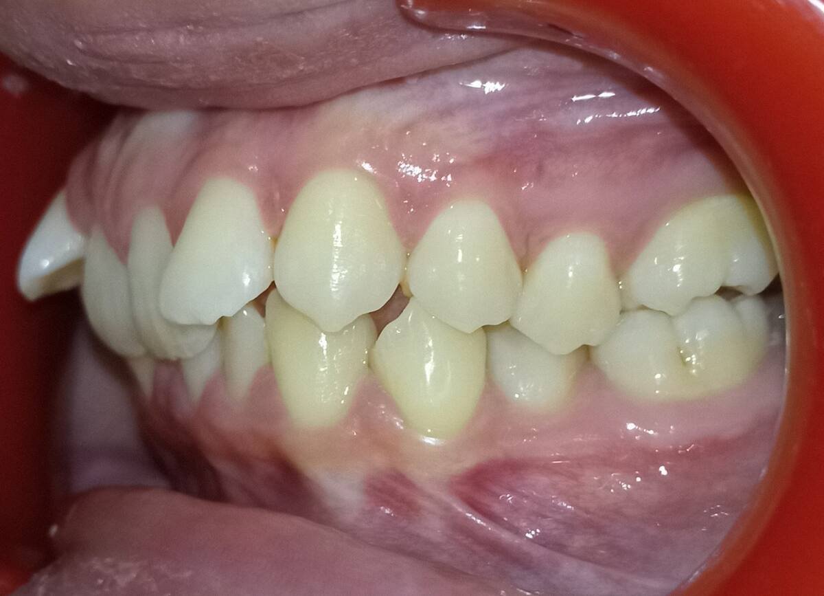 Before — left lateral, Class II crowding