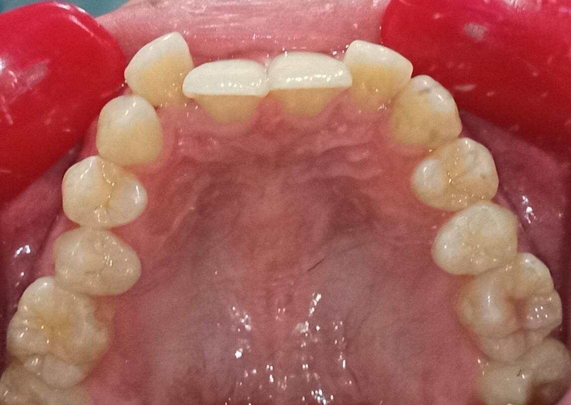 Before — upper occlusal, severe crowding and retroclined incisors