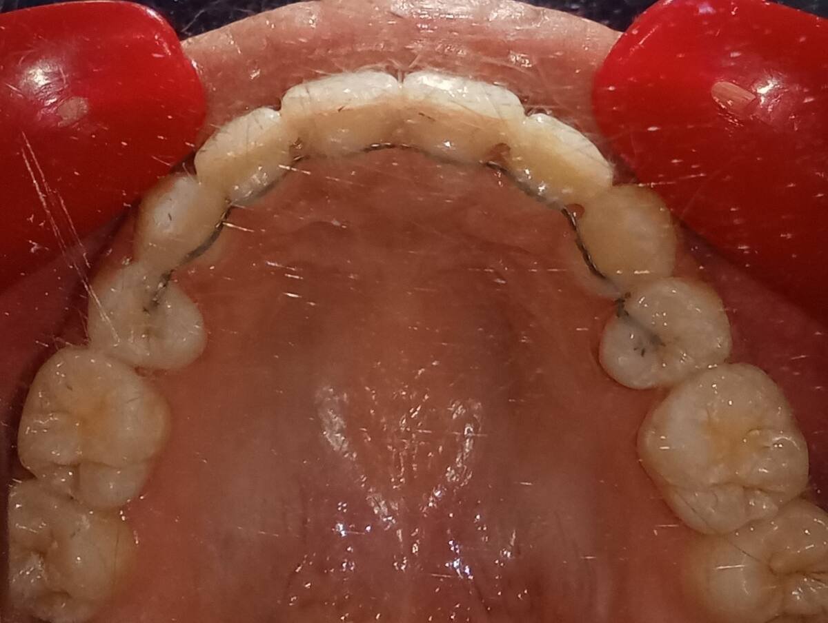 After — upper occlusal, well-aligned arch with bonded retainer