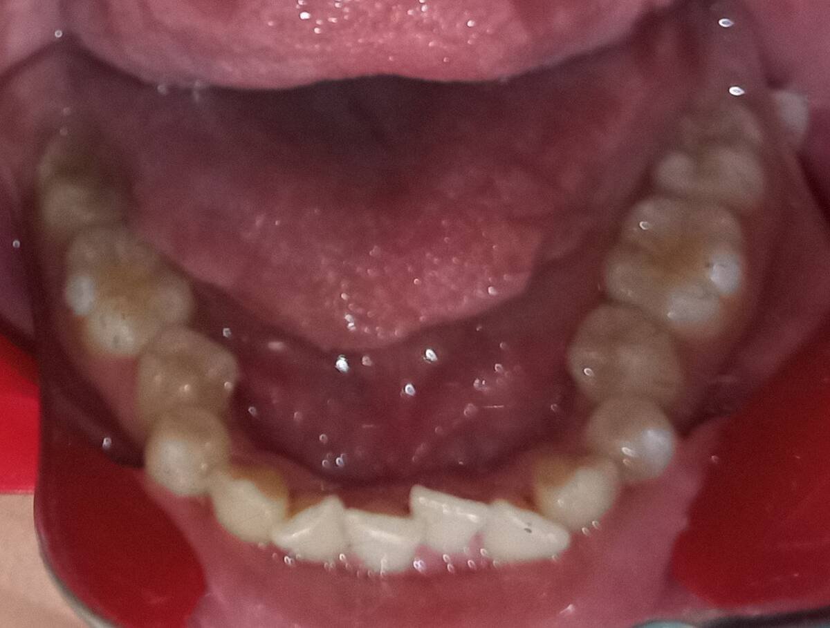 Before — lower occlusal, severe crowding