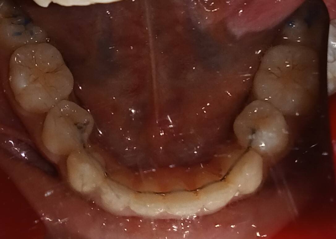 After — lower occlusal, aligned arch with bonded retainer