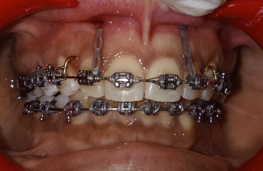 Braces with mini-implants (TADs) placed during Class II deep bite treatment