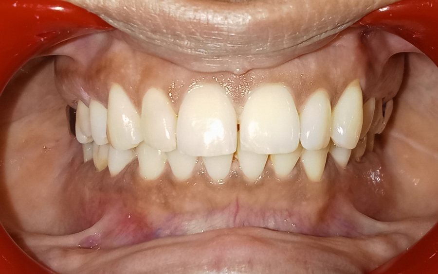 Class II deep bite front view before treatment
