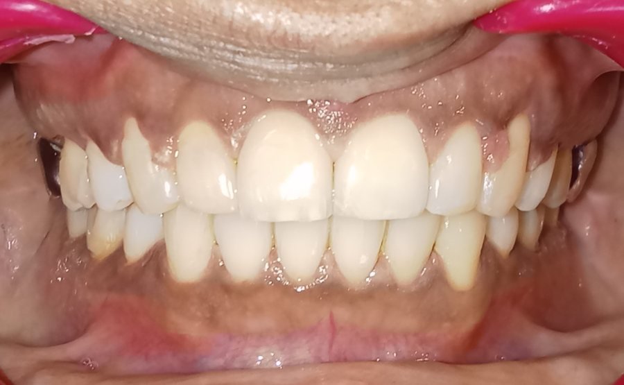 Class II deep bite front view after treatment, ideal overbite