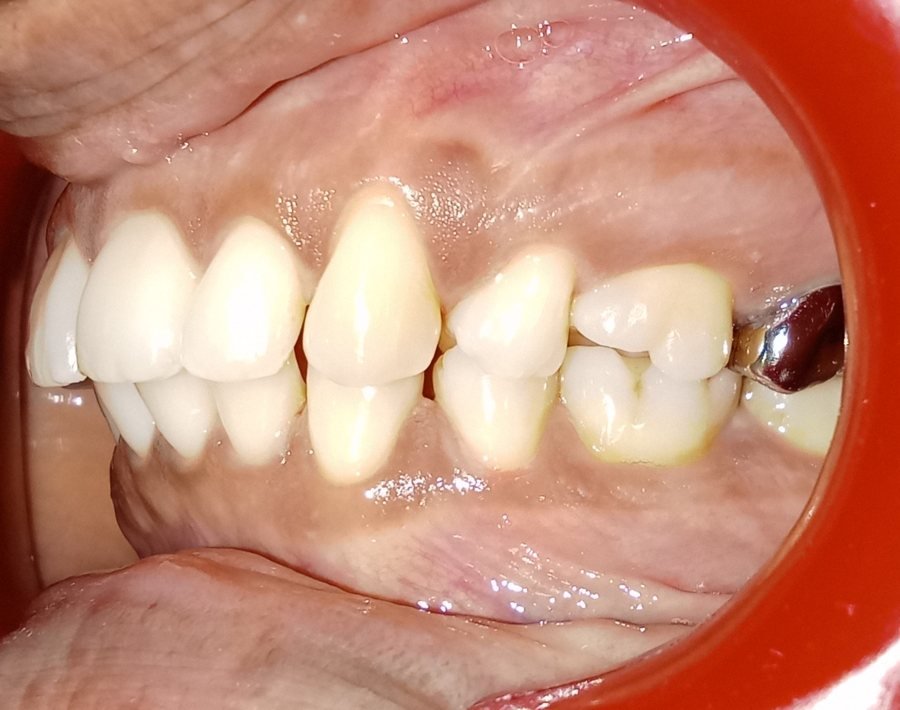 Right side view before treatment