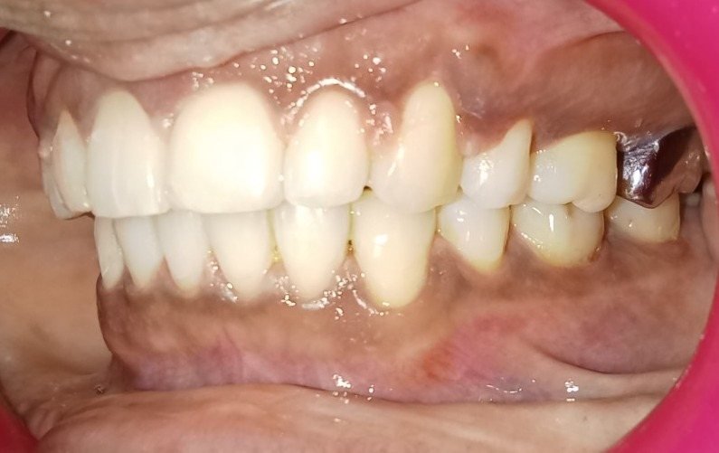 Right side view after treatment