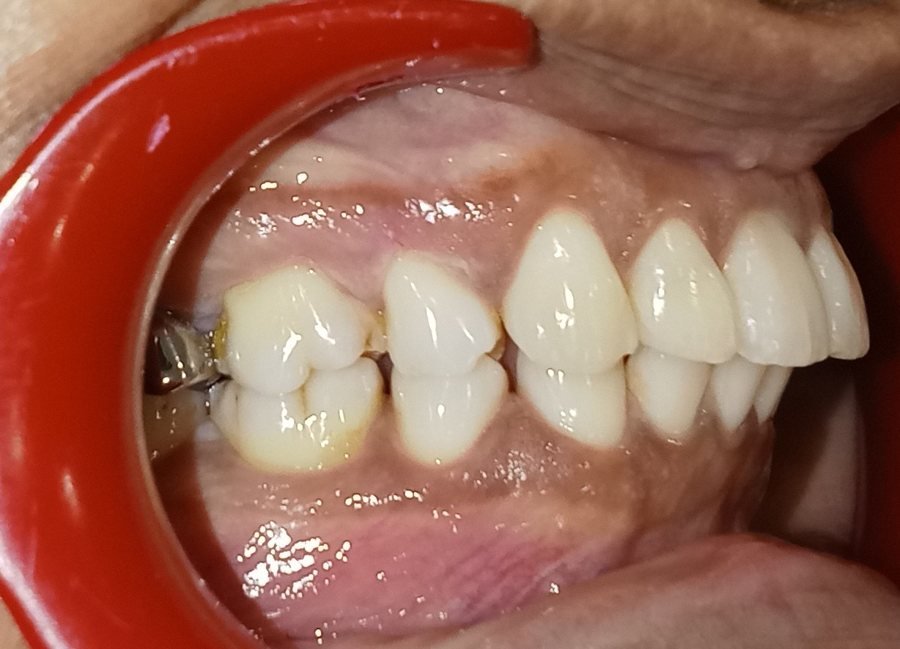 Left side view before treatment