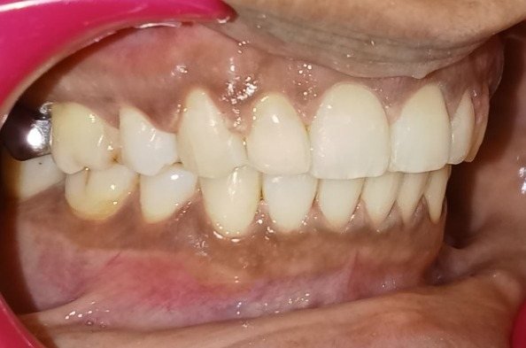 Left side view after treatment