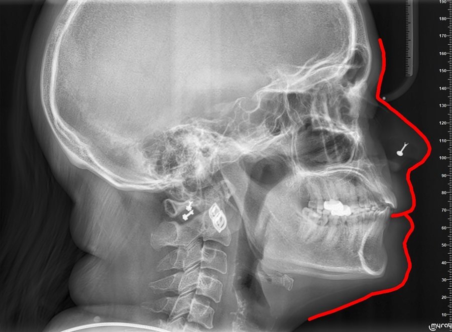 Cephalometric X-ray after treatment showing improved profile