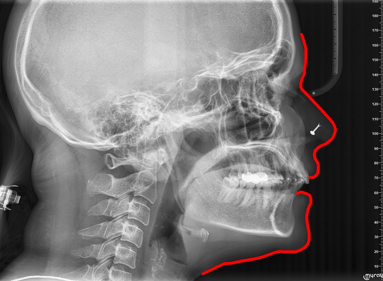 Cephalometric X-ray before treatment showing lips apart and a protruded soft-tissue profile traced in red