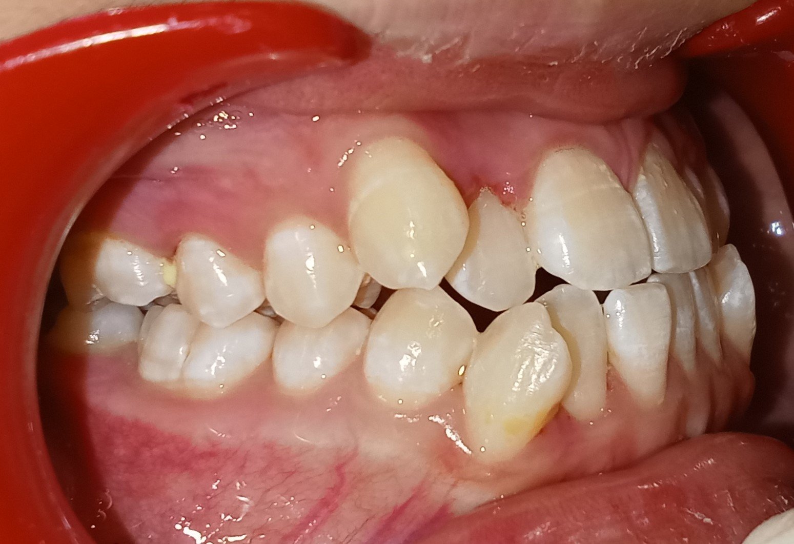 Right side before treatment — Class III crossbite Doha
