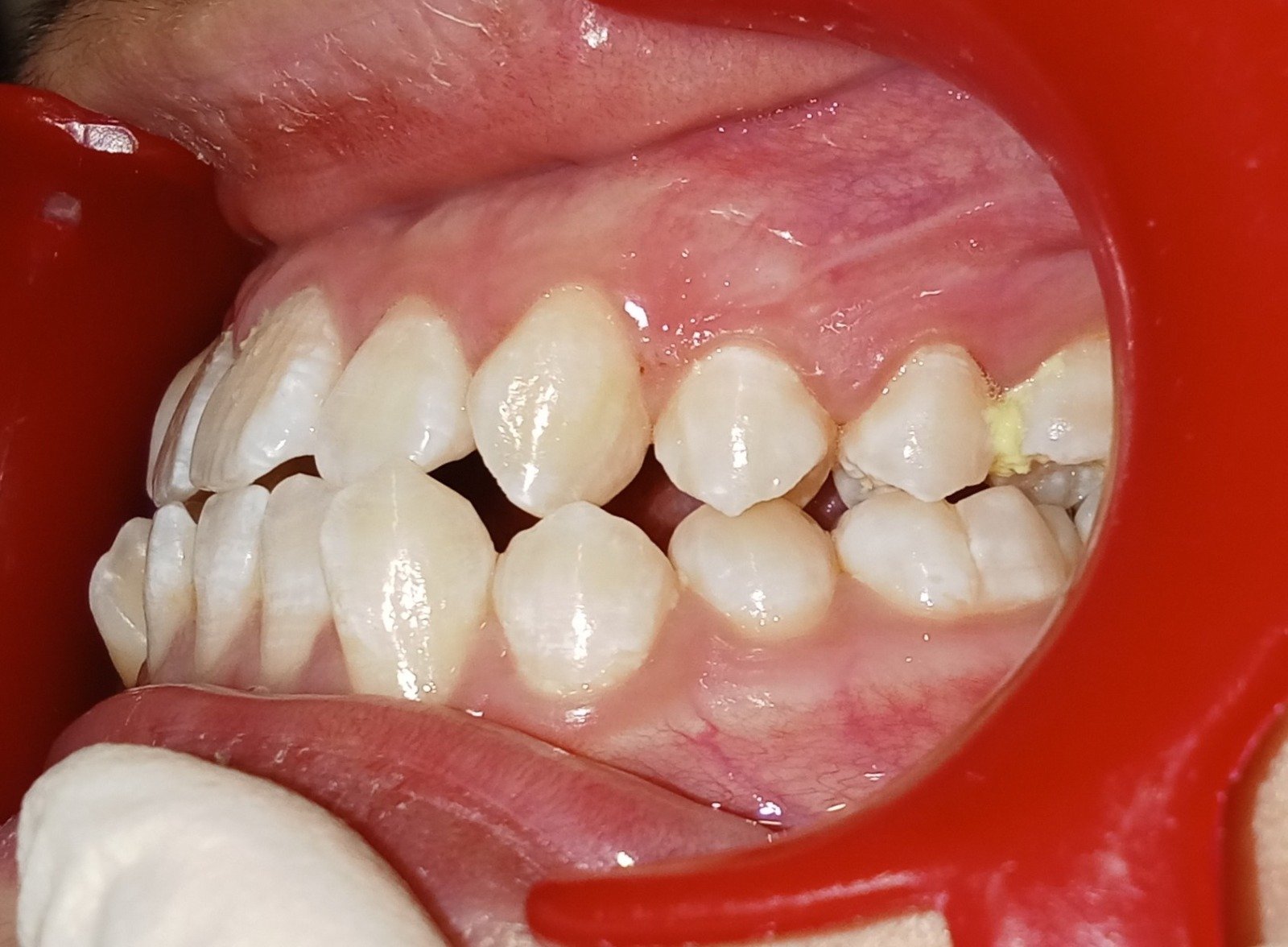 Left side before treatment — crowding and crossbite