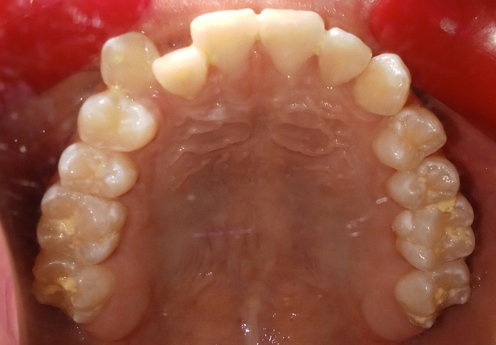 Upper arch before treatment — severe crowding
