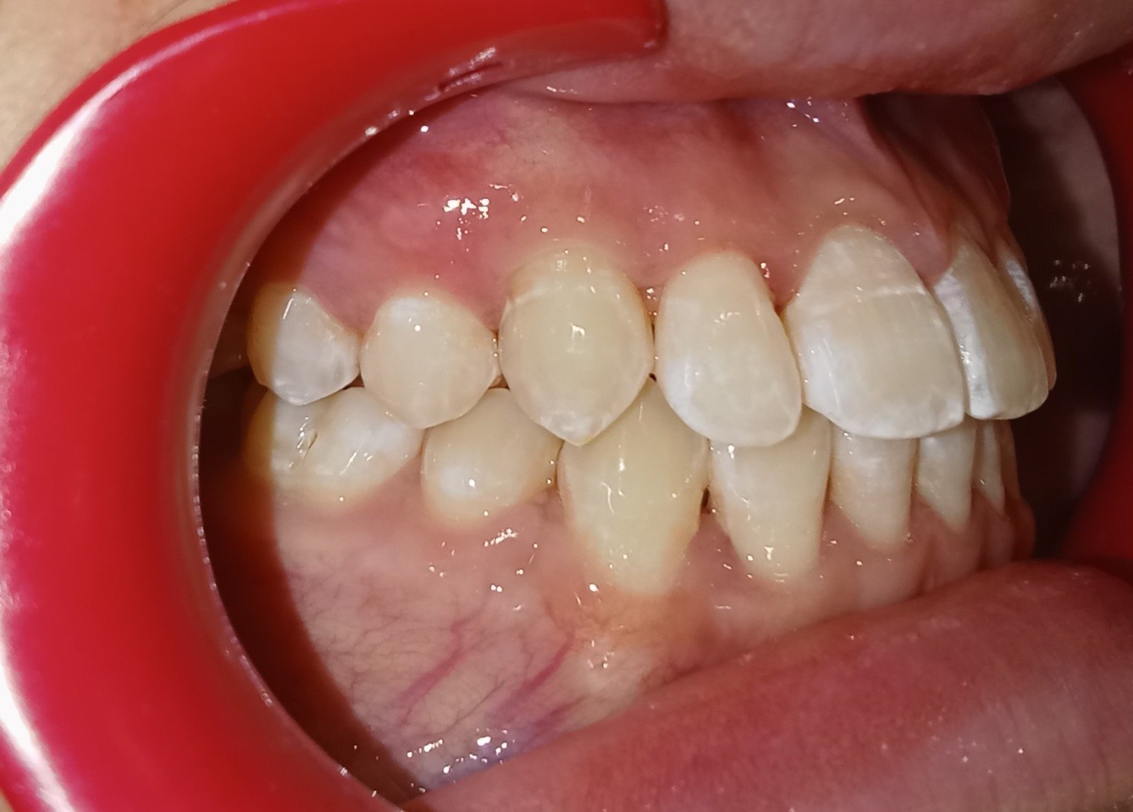 Right side after treatment — crossbite corrected Doha