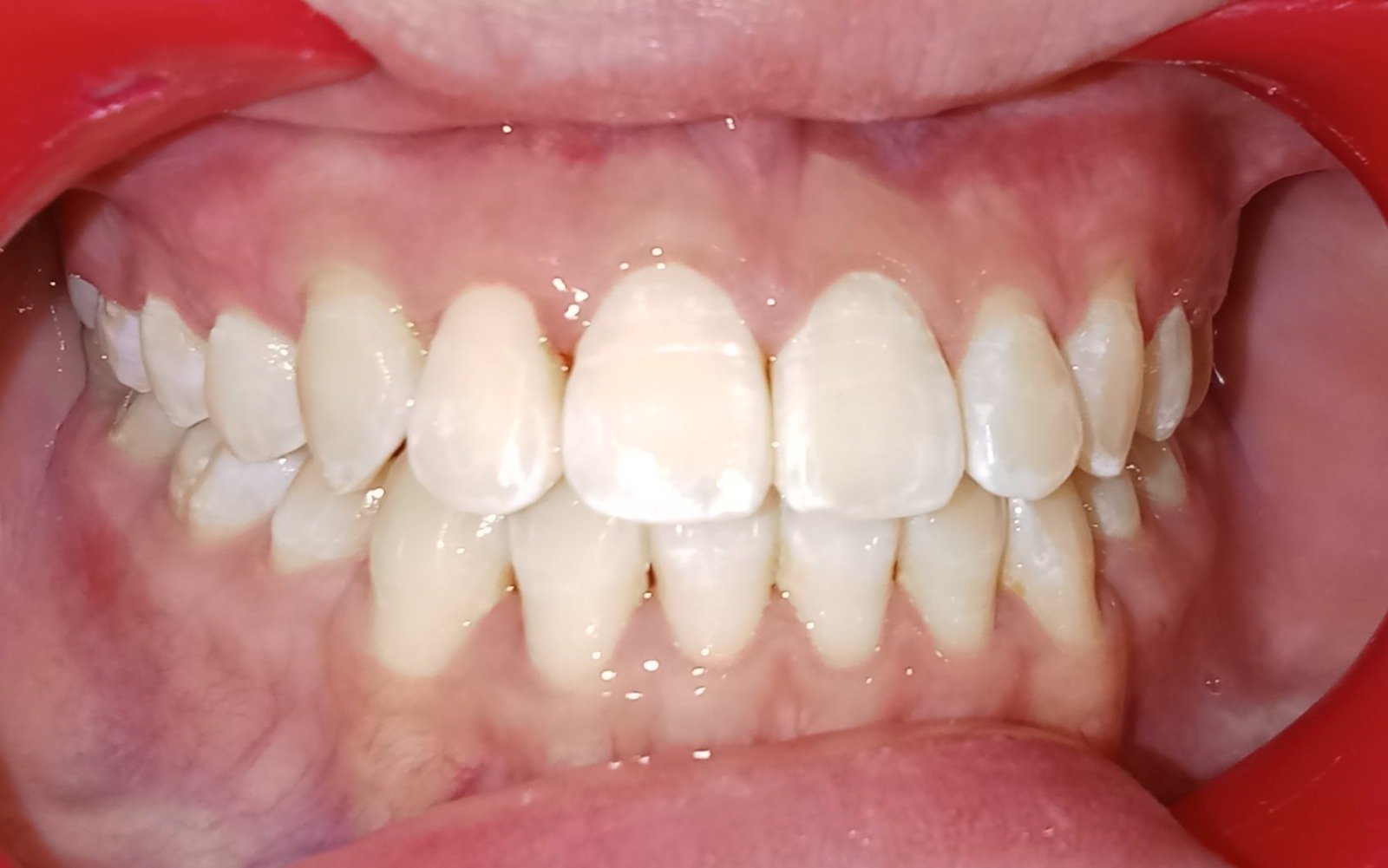 Front view after treatment — Class III corrected