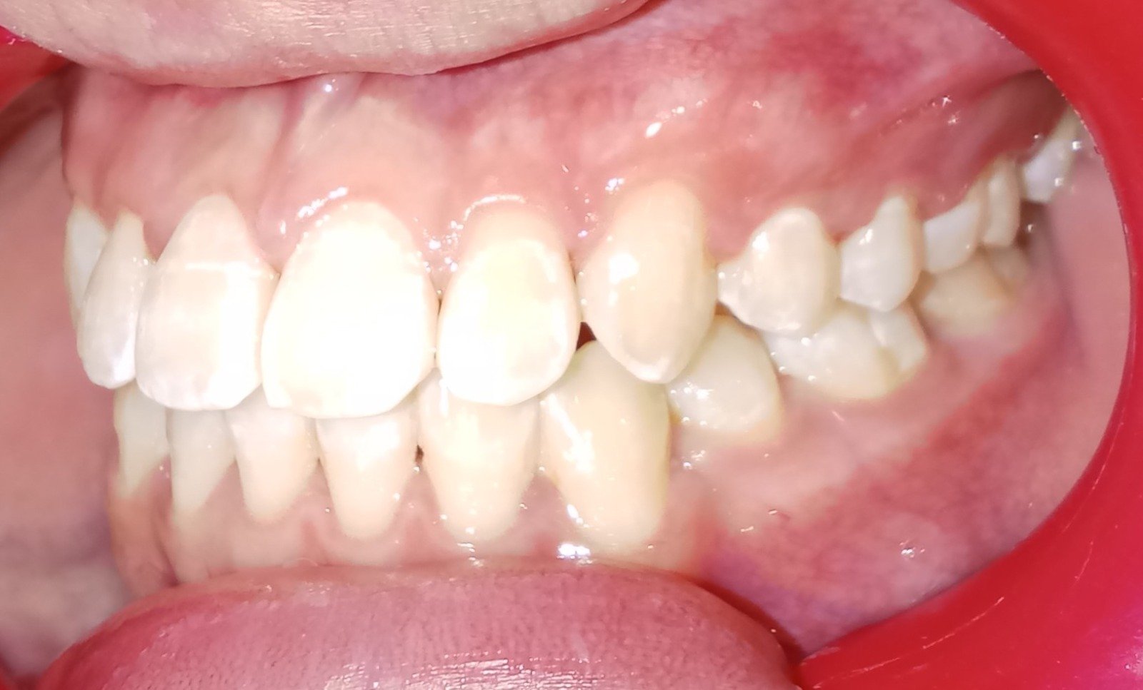 Left side after treatment — aligned bite