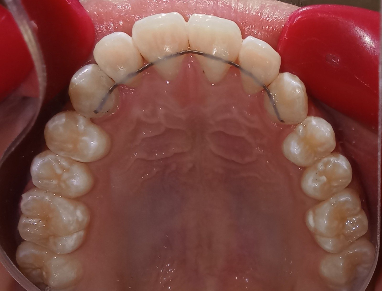 Upper arch after treatment — aligned and retainer in place