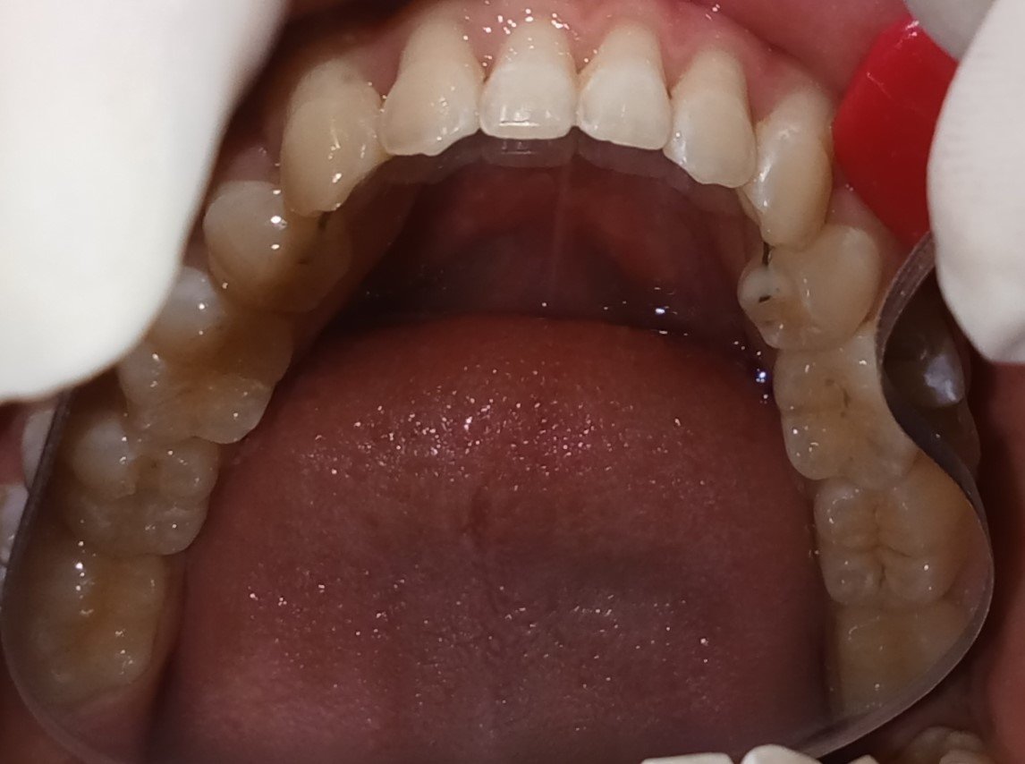 Lower arch after treatment — post extraction alignment