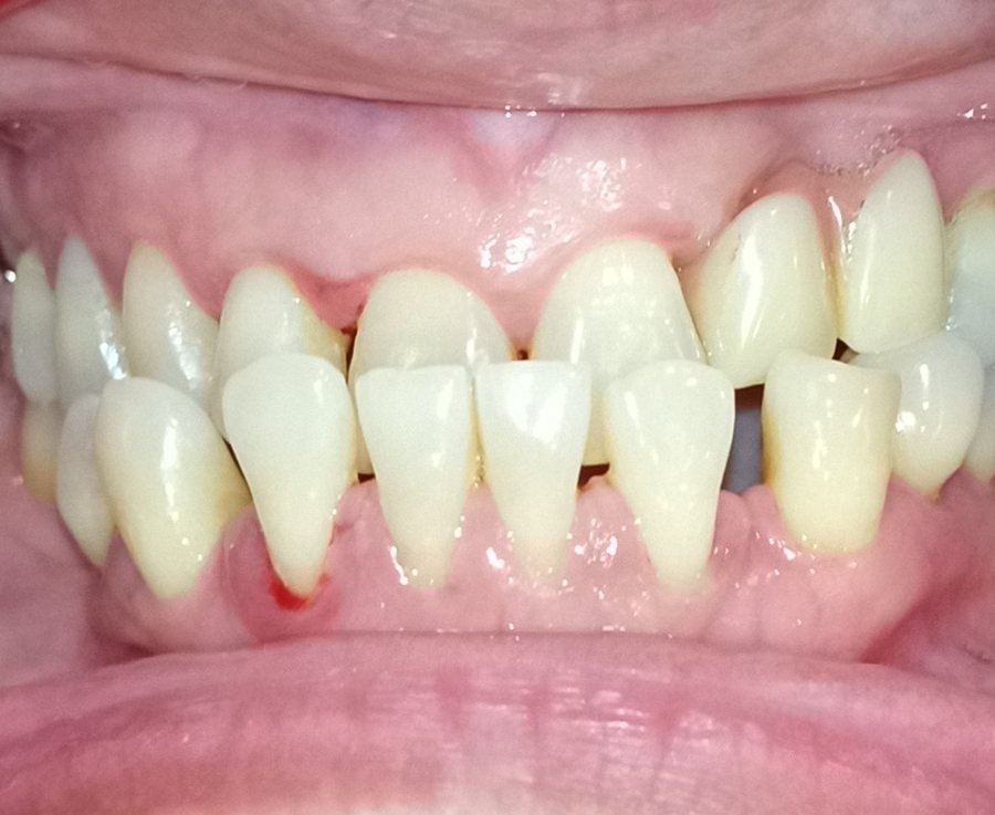 Anterior crossbite front before