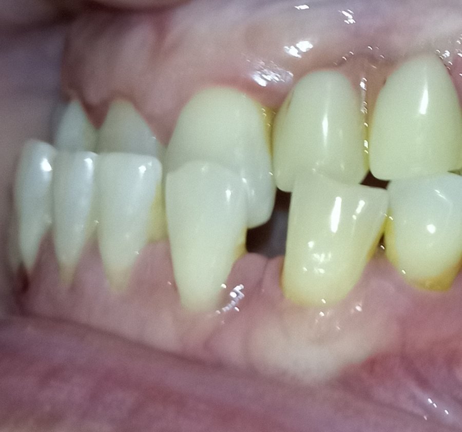 Left side before