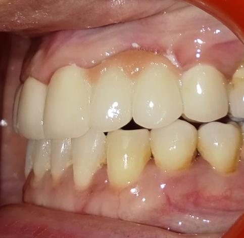 Left side after