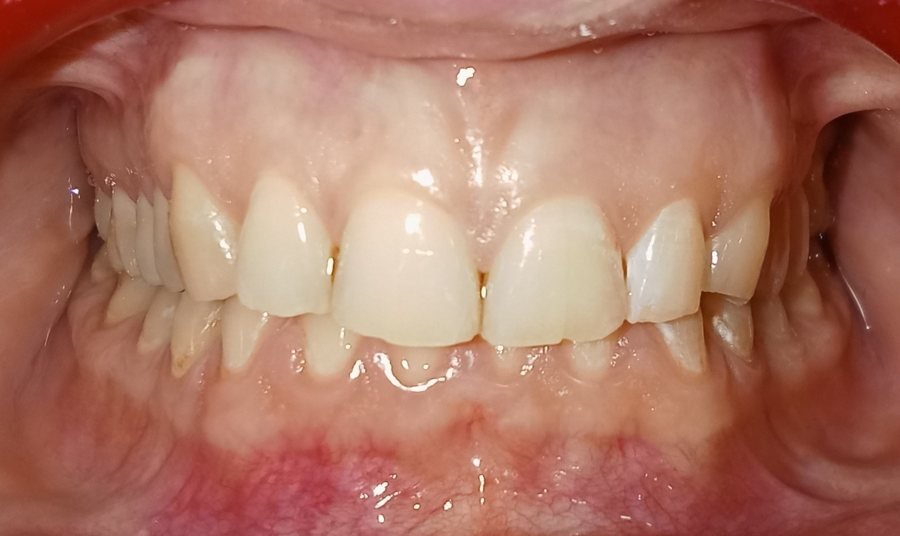 Deep bite front view before