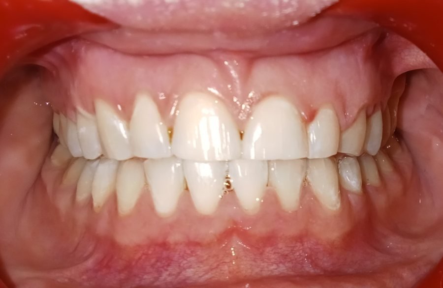 Corrected bite front view after