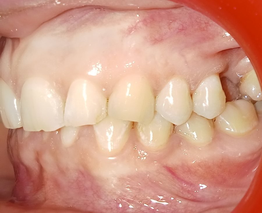 Left side before