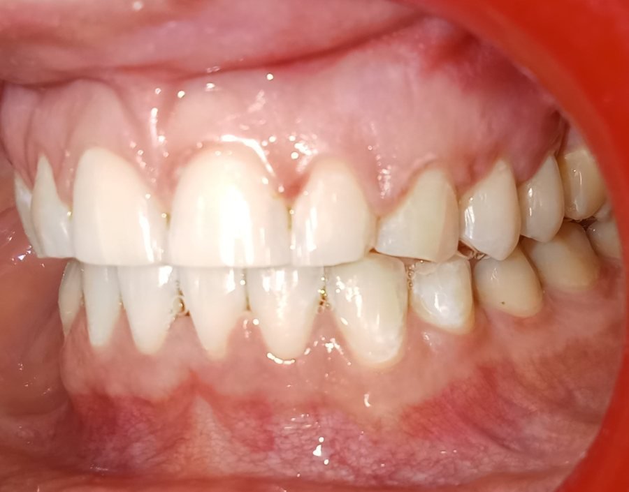 Left side after