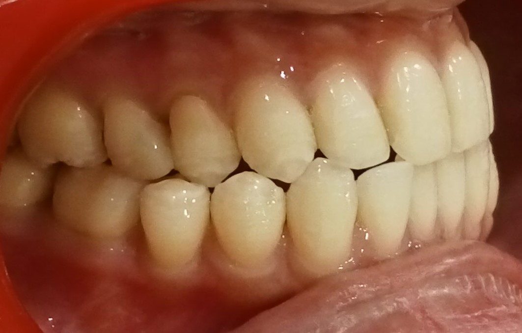 Before — right lateral view