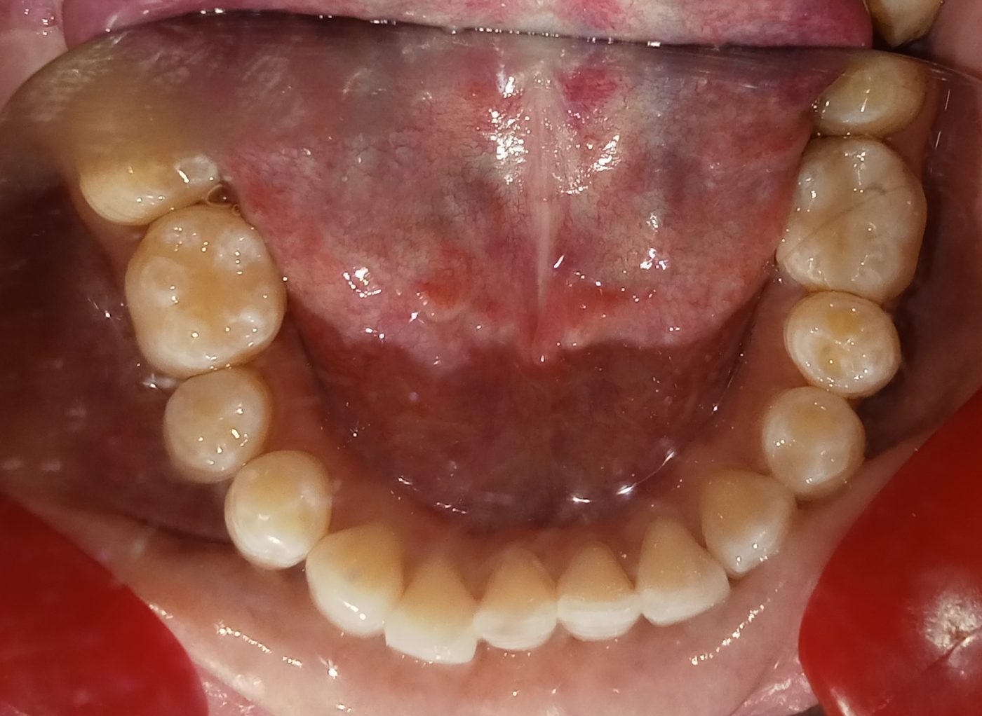 Before — lower arch occlusal view