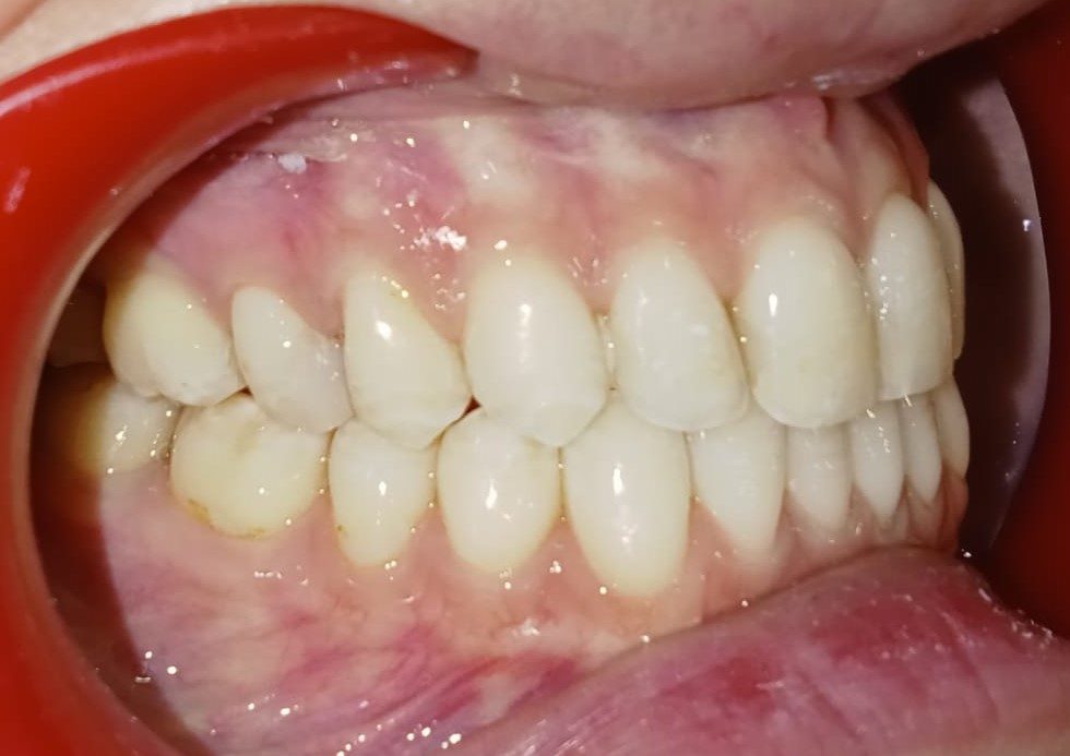 After — right lateral view