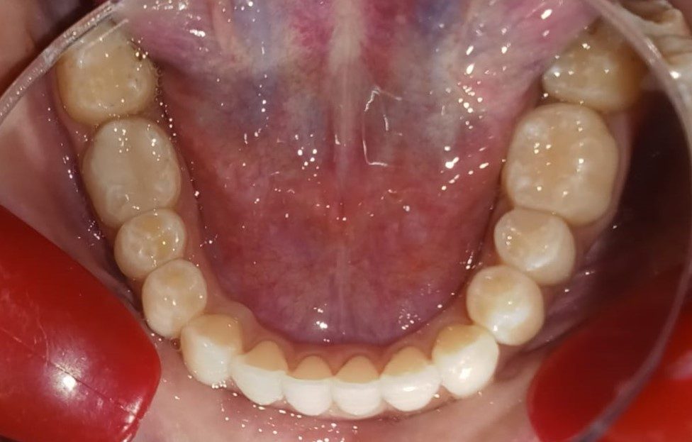 After — lower arch occlusal view