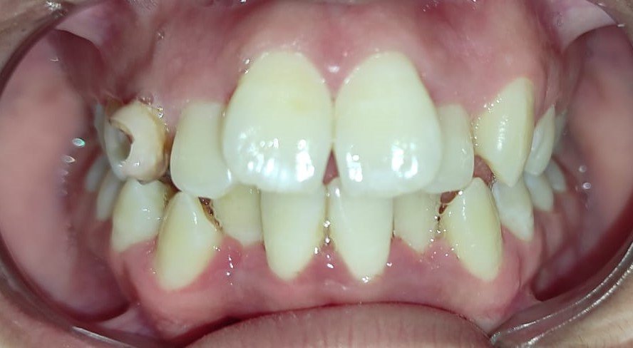 Before — frontal view showing severe crowding and forward placement