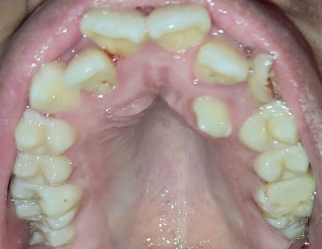 Before — upper occlusal view showing severe arch crowding