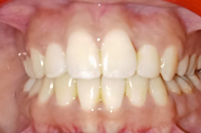 After — frontal view, teeth beautifully aligned