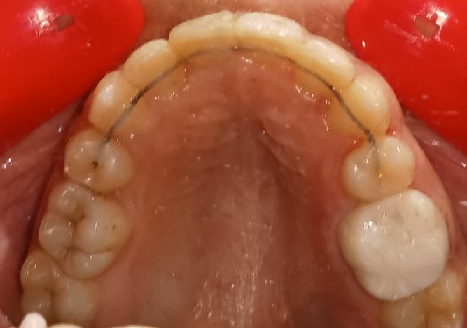 After — upper occlusal view showing perfectly aligned arch with retainer