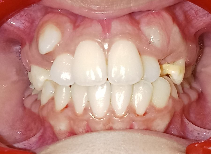 Impacted canine front view before treatment