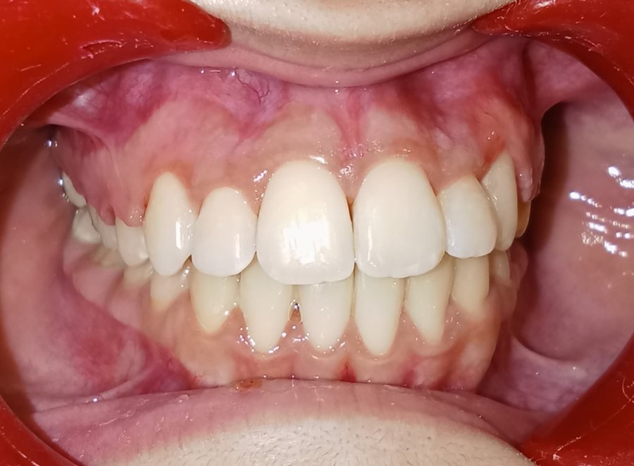 Impacted canine front view after treatment