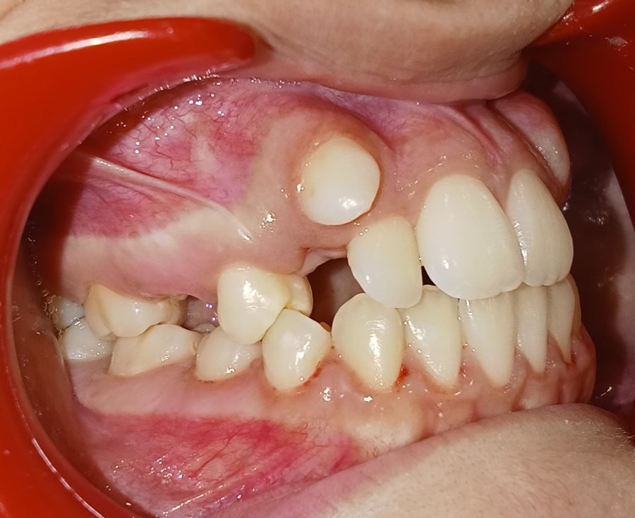 Impacted canine side view before treatment