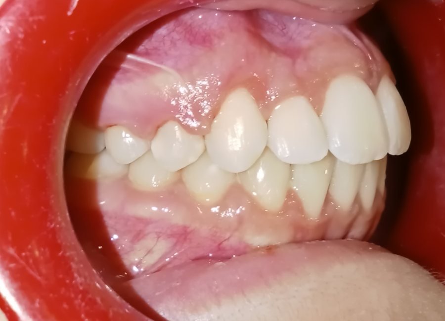 Side view after treatment